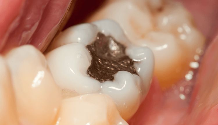 حشوة الزئبق للأسنان Mercury dental filling