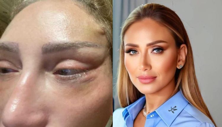 ريهام سعيد تتهم طبيب التجميل بتشويه وجهها Reham Saeed accuses the plastic surgeon of disfiguring her face